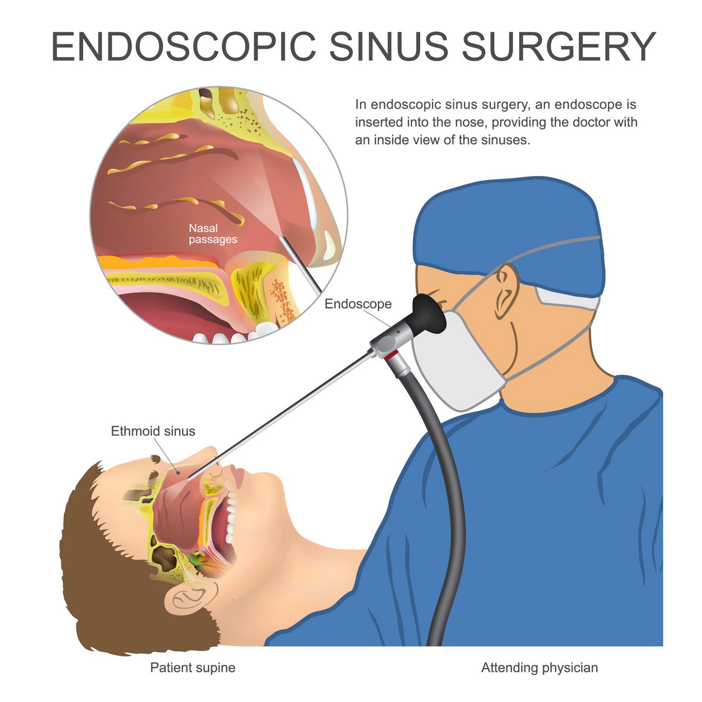 Nasal papilloma removal